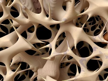 Οστεοπόρωση